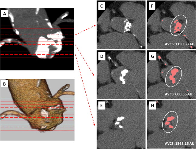 A whole image of AVCS calculation by using MSCT was presented in panels A–B. ...