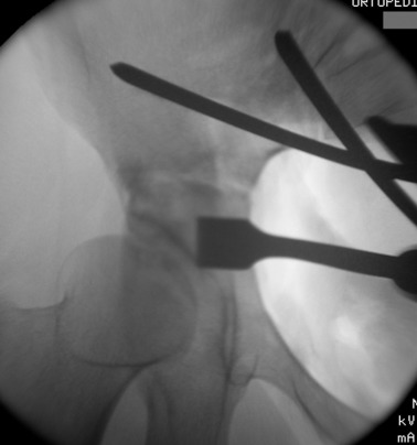 Posterior colon osteotomy.