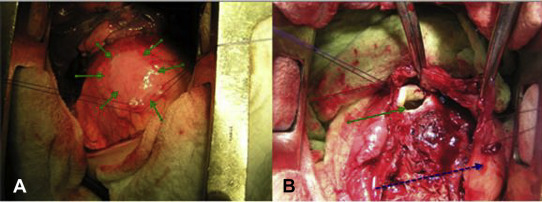 Pericardial hydatid cyst with thick fibrous pericyst and no adhesions to the ...