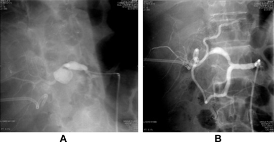 Hepatic artery angiography for Case 2. (A) Pseudoaneurysm at the anastomotic ...