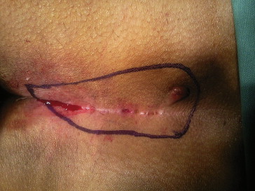 Marking of excision.