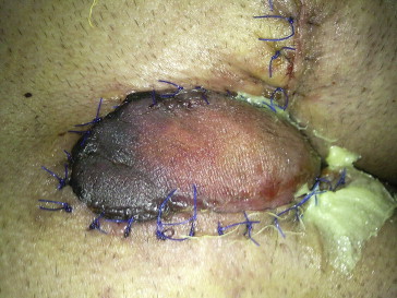 View of echimosis in flap.