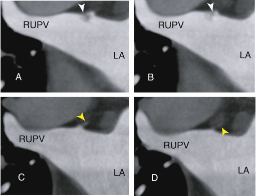 (A, B) Axial images showing a thrombus (3 to 4mm) within the right upper ...