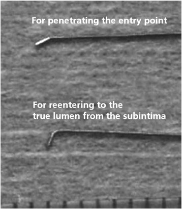A 30 to 60 degree distal bend 1 to 2mm from the tip should be placed on the wire ...