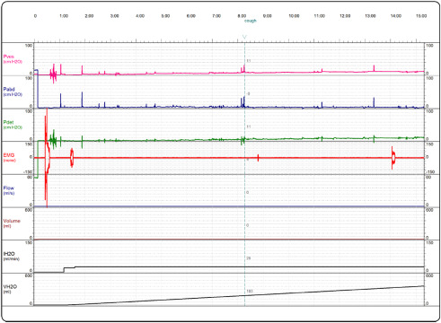 Exame urodinâmico do mesmo paciente após o tratamento com BTX‐A.
