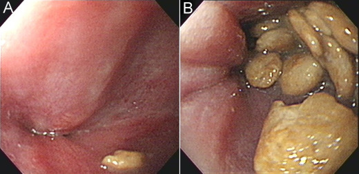Repeated esophagogastroduodenoscopy. (A) A very tight gastroesophageal junction ...