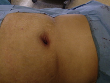 Closure of the single port incision.