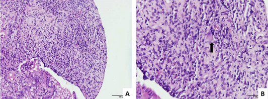 (A) Histopathology shows ulcerative debris and granulation tissue under ...