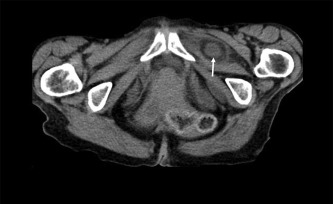 Incarcerated small bowel between the external obturator and pectineal muscles ...