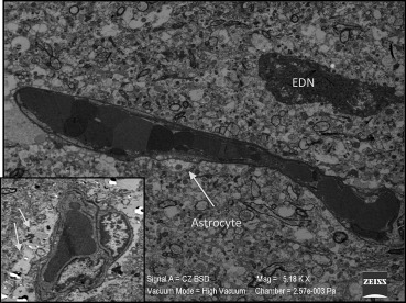 Precapillary astrocytic edema (smaller figure on the bottom right) and electron ...