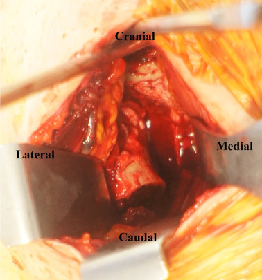 Pubic rami osteotomy was easily performed due to its close position to the ...