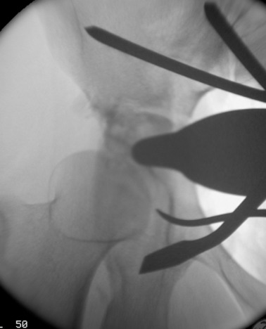 Ischium osteotomy.