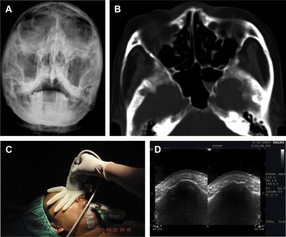 (A) Conventional Waters view showing negative findings and poor imaging quality ...