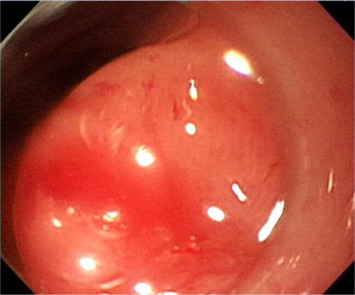 Suction is applied to draw the flat lesion into the cap and, on the release of ...