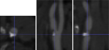 Caso clínico. Angio-TC de la zona cercana a la bifurcación carotídea, en escala ...