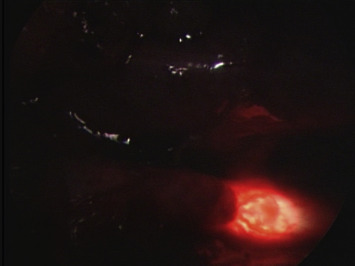 Light from the ureteroscope could be seen through the ureter under laparoscopy.