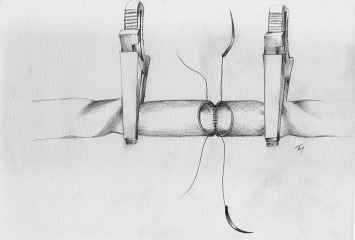 The artery is twisted 90° to the left side instead of 180° rotation once to ...
