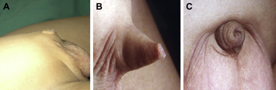 (A) Group A: severe penile skin deficiency; (B) Group B: moderate penile skin ...