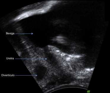 Imagem ecográfica em plano para‐sagital obtida com sonda transvaginal de ...