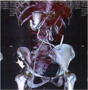 CT angiography showing agenesis of abdominal aorta, collaterals reconstituting ...