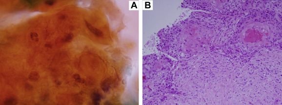 Pathological analysis. (A) Analysis of the fine-needle aspiration (FNA) ...