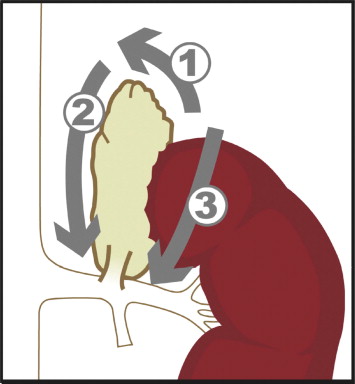 Sequence of dissection for left adrenalectomy. The dissection started at the ...