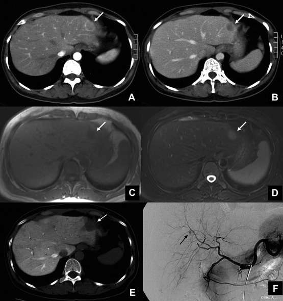 Image findings of the lesion. (A) Abdominal computed tomography (CT) scans ...
