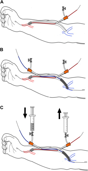 (A) Drawing the steps of cross-balloon occlusive thrombolysis for a thrombosed ...