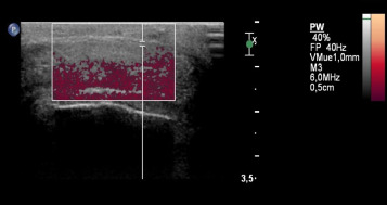 Trombose da veia superficial dorsal do pénis.