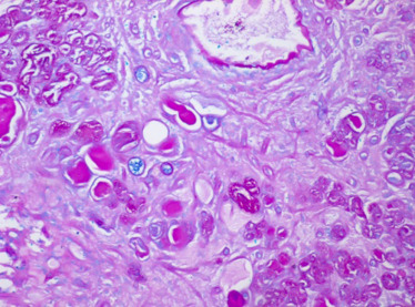 Estruturas tubuloglandulares com mucinas neutras (PAS+) e mucinas ácidas (Alcian ...