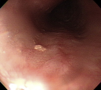 EGD revealed a single 0.3-cm yellowish plaque at 33 cm from the incisor. It ...