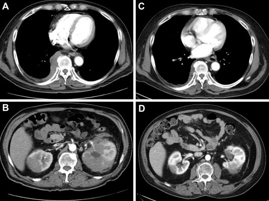 (A) Infiltrating right posterior mediastinal and paraspinal masses with pleural ...