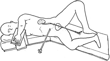 Position for concurrent laparoscopy and retrograde ureteroscopy.