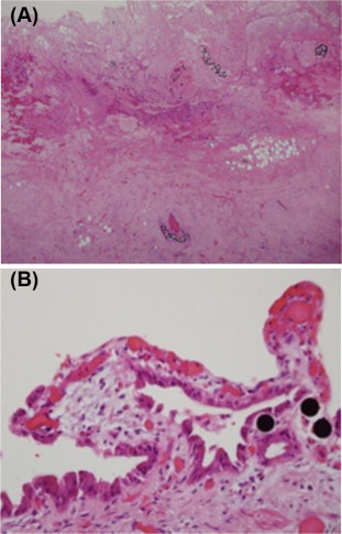 (A) Microscopy of infarcted gallbladder wall with spheres in lymphovascular ...