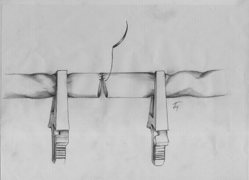 The artery is twisted 90° to the right side.