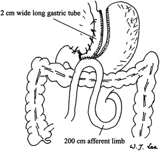Laparoscopic minigastric bypass (LMGB).