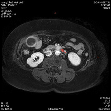 Magnetic resonance imaging with contrast enhanced (T2 weighted) revealed an ...