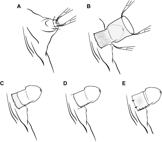 The procedures of the technique. (A) Circumferential incision to enlarge the ...