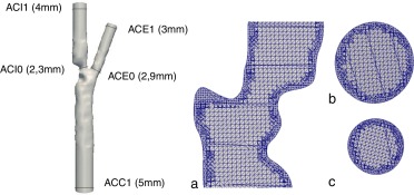 Caso clínico. Izquierda: modelo tridimensional segmentado a partir de la imagen ...