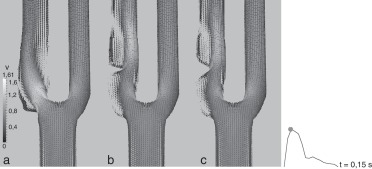 Carótidas idealizadas. Velocidades en el plano de simetría en la sístole (m/s).