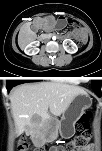 Abdominal computed tomography confirmed a 7.5 cm gallbladder cancer with liver ...