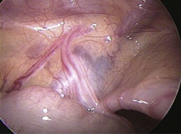 Vanishing testis. The vas deferens and vessels enter the inguinal canal.