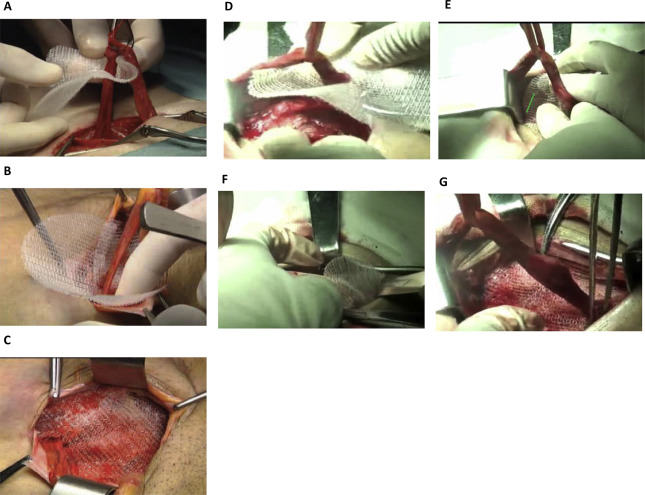 Mesh placement procedures. (A–C) Traditional mesh placement. (D–G) Modified mesh ...