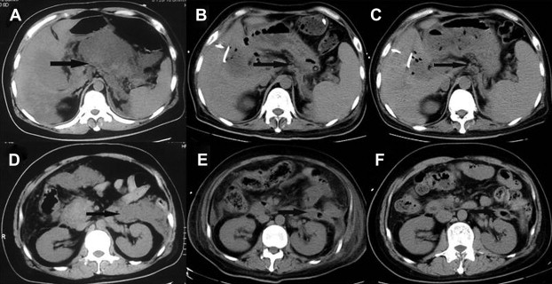 Laparoscopic retroperitoneal debridement and gallbladder puncture and drainage ...