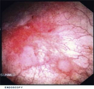 Cystoscopic view of the inflamed urothelium of the bladder.