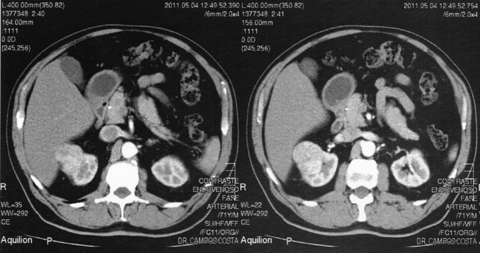 Resultados da tomografia axial computorizada abdominal com contraste (cortes ...