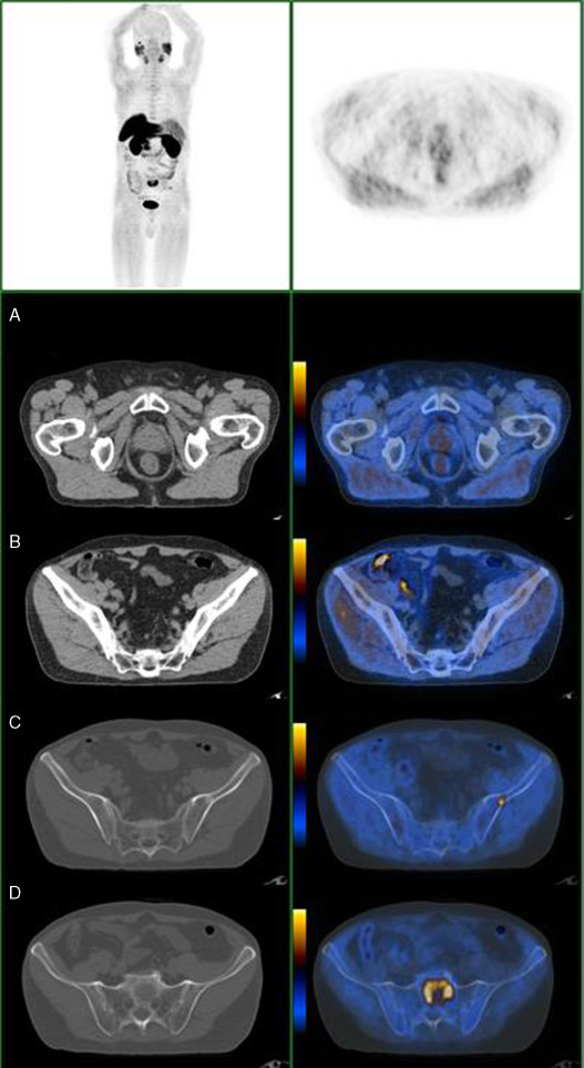 Doente com CaP com PSA de 11ng/mL, com doença prostática (A), metástase ...