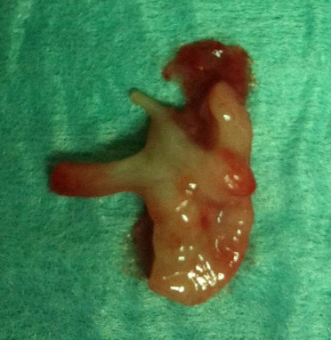 Peça operatória. A seta indica um pólipo intraureteral.