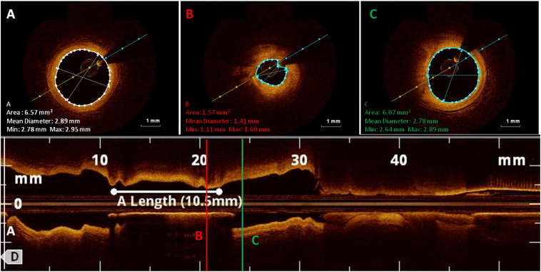 FD-OCT B-scans (cross-sectional images) of the vessel wall with calculated lumen ...