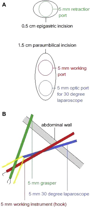 (A) The skin incisions and port insertions during stage two of a two-incision ...